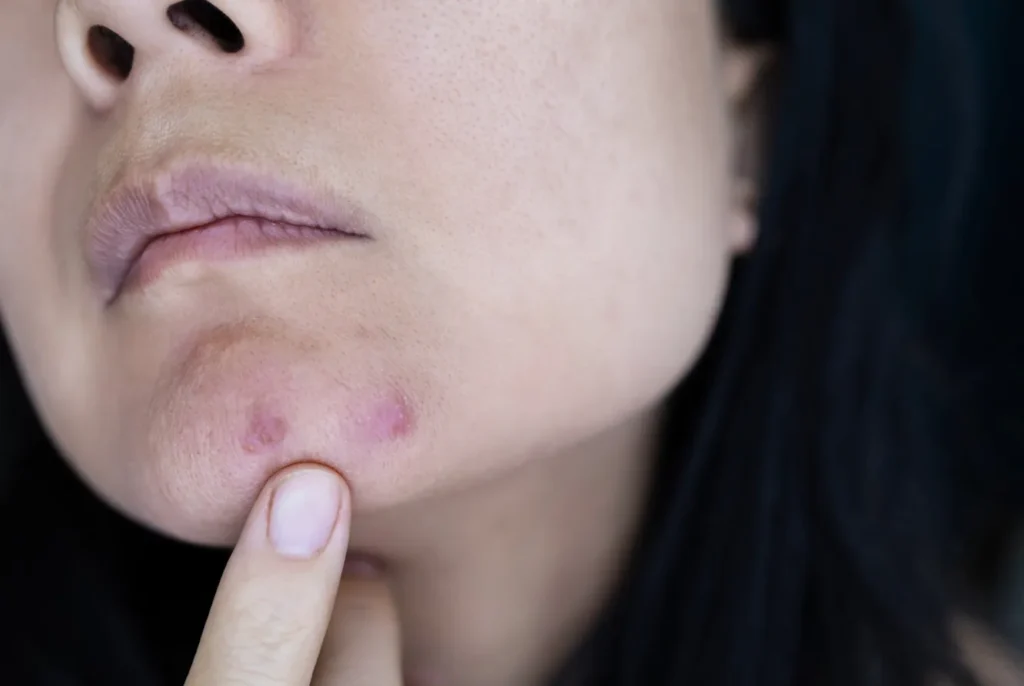 Doctronic Explaining the Differences Between Ingrown Hairs and Herpes
