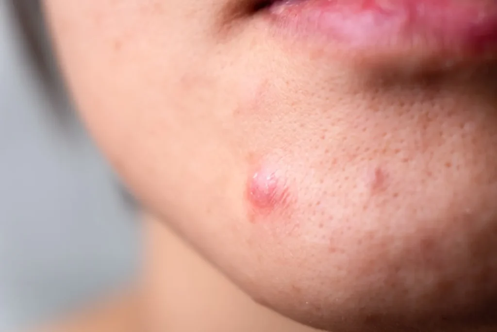 Doctronic Explaining the Differences Between Ingrown Hairs and Herpes