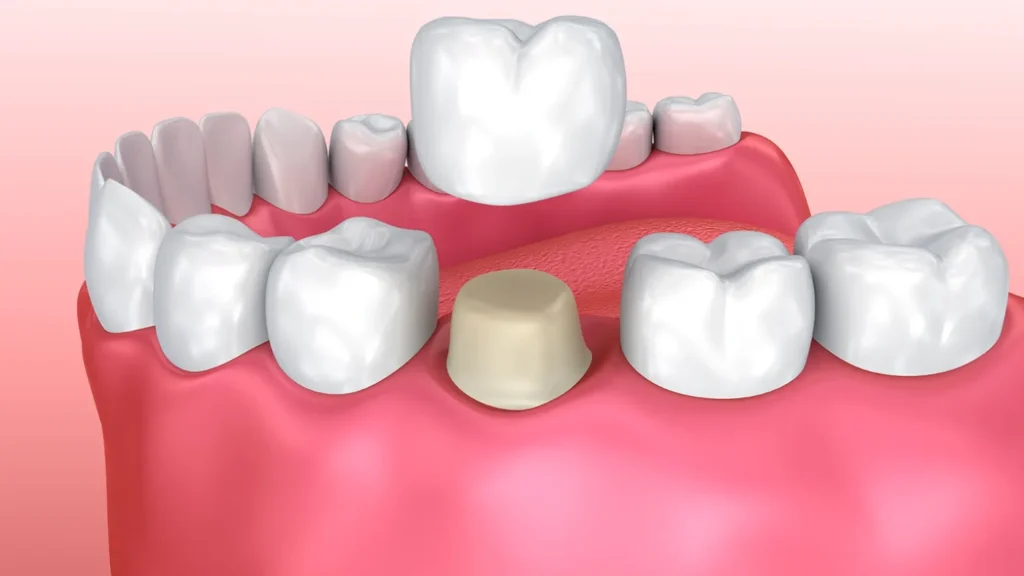 The Many Faces of Dental Crown Costs in Sydney What You Need to Know